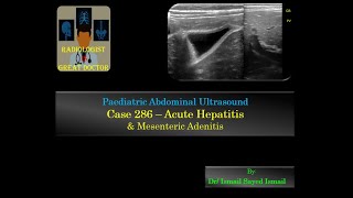 Ultrasound Case 286  Acute Hepatitis and Mesenteric Adenitis [upl. by Kyla]