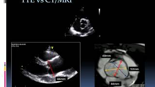 Echocardiographic assessment of bicuspid aortic valve [upl. by Ahseid]