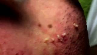 Acne Solution  Blackheads amp Whiteheads Removal 1  How to get rid of acne [upl. by Mata557]