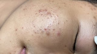 ACNE TREATMENT VU QUYNH MI  Blackheads On Boy Face 2024FULL [upl. by Letnuahc675]