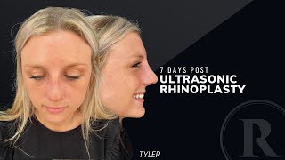 Tyler’s Story Ultrasonic Rhinoplasty PostOp Day 7 [upl. by Nomde462]