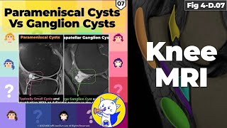 Fig 4D07 Comparison of Parameniscal Cysts and Infrapatellar Ganglion Cysts [upl. by Lona]