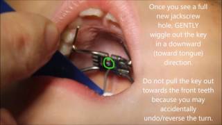 How To Turn a Rapid Palatal Expander [upl. by Sculley]