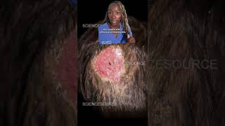 Is Your Scalp Itching Discover the Causes of Scalp Ringworm Tinea Capitis [upl. by Enawd]