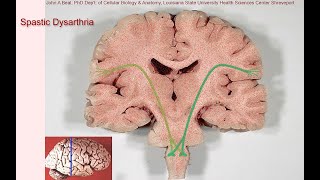 Spastic dysarthria  samples and tutorial [upl. by Belford]