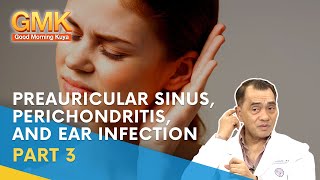 Preauricular Sinus Perichondritis and Ear Infection Part 3  Usapang Pangkalusugan [upl. by Nalorac196]