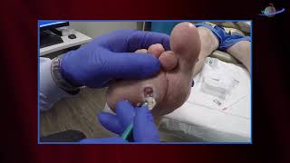 WCW Debridement of Neuropathic Foot Ulcer [upl. by Nevak]