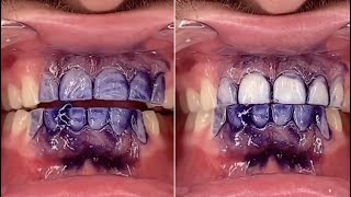 V34 Mousse Teeth Whitening Purple Toothpaste Review  hismile toothpaste [upl. by Atiugram]