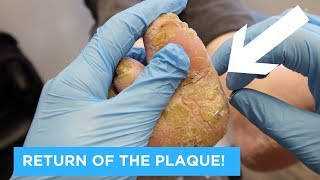 RETURN OF THE PLAQUE  PSORIATIC PLAQUE PART 2 [upl. by Sidwell]