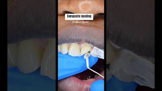 Composite Bonding on front tooth viral composite compositebondingcosmeticssmileteethdentist [upl. by Grimona448]