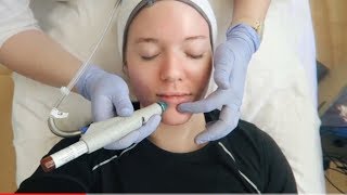 HYDRAFACIAL TREATMENT Before amp After [upl. by Eelimaj]