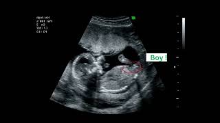 15 weeks active fetus  Its a Boy  By CRL  Ultrasound Case [upl. by Skricki18]