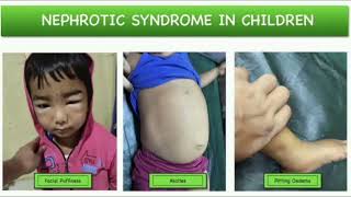 Nephrotic syndrome History mrcpch Clinical [upl. by Whang]