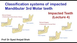 Classification system of Impacted Mandibular 3rd Molar  Pell amp Gregory  Syed Amjad Shah [upl. by Sirronal]