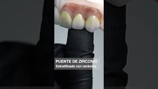 Puente de Zirconio estratificado con cerámica y cerámica de encía impresión dental guayaquil [upl. by Aleris]