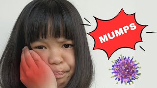 Mumps  Causes Signs amp Symptoms Diagnosis And Treatment [upl. by Eslud453]