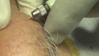 Permanent painless hair removal of chin electrolysis [upl. by Aicirtap]