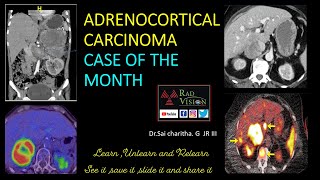 Adrenocortical carcinoma CASE OF THE MONTH [upl. by Adnileb]