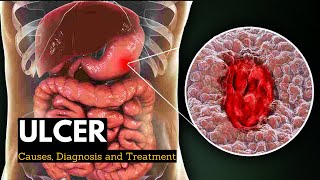 Ulcer Causes Signs and Symptoms Diagnosis and Treatment [upl. by Allehcram633]