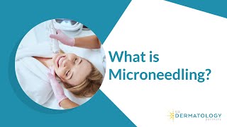 What is Microneedling  Microneedling Treatment [upl. by Evadnee699]