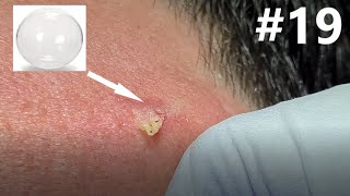 BLACKHEAD EXTRACTION on Happy 19 [upl. by Urbannai]