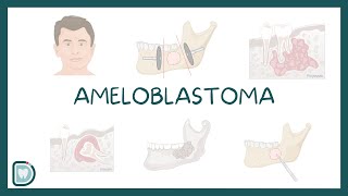 Understanding Ameloblastoma Causes Diagnosis Types and Treatment [upl. by Aisekal]