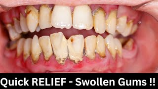 Swollen Gums Home Remedy  Quick relief for swollen gums [upl. by Ermanno]