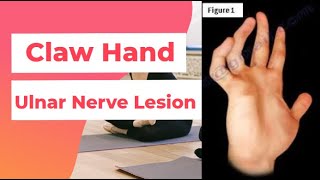 Claw Hand  Ulnar Nerve Lesion  PhysiotherapyKnowledge [upl. by Taite593]