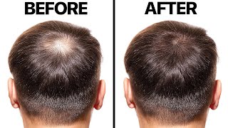 Minoxidil for Hair Loss [upl. by Jowett]