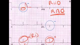 ECG in PE  A Primer [upl. by Keever992]