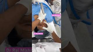 Rapid sequence Intubation  Intubation Airway Management RSI  doctor reels shorts neet [upl. by Rodi939]