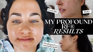 Profound Radio Frequency® Skin Tightening  my results 1 year later [upl. by Merola]