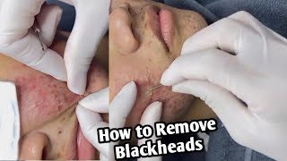 Acne Removal Treatment  Acne amp Pimple Treatment  Blackhead Removal  Remove Blackheads [upl. by Reuben]