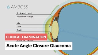 Acute Angle Closure Glaucoma [upl. by Marilla]