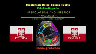 Echokardiografia  Hipokinezja DolnoBoczna I Dolna [upl. by Pooh616]