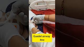 Guedel airway insertion tip and tricks The Guedel Airway A Crucial Tool in Emergency Medicine [upl. by Jule]