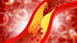 Foods To Prevent Atherosclerosis Clogged Arteries [upl. by Jolee569]