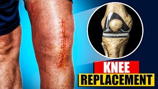 Total Knee Replacement Surgery 3D Animation  3D Animation of a Knee Replacement  Joint Replacement [upl. by Drucill53]