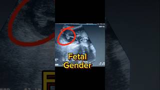 Easy Fetal Ultrasound  Gender Revealing  Anomaly Scan  3rd Trimester Third [upl. by Leonteen]