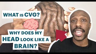 What is CVG Cutis Verticis Gyrata  A detailed look into this WEIRD scalp condition [upl. by Yknarf]