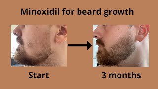 My results from using minoxidil for beard growth [upl. by Esinyl980]