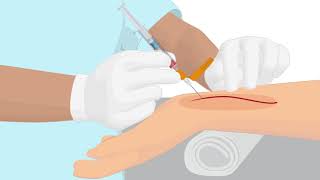 How to properly handle an arterial puncture blood gas sample [upl. by Melitta]