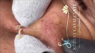 ACNE TREATMENT  Super Satisfying blackheads  004 [upl. by Jezabel]