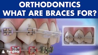 How Braces Work Elements of the orthodontic treatment and its role © [upl. by Nemrac]