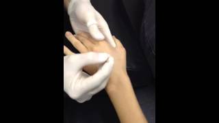 Adductor Pollicis Dry Needling [upl. by Teodor]