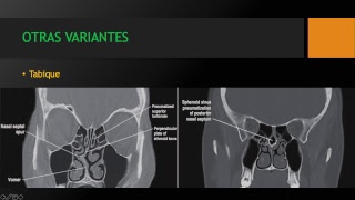 Anatomía y patología de los senos paranasales Dr Franklin O Ordoñez [upl. by Roseanne]