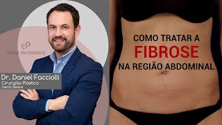 Clube da Plástica Como tratar a fibrose na região abdominal [upl. by Colline602]