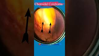 RP changes with choroidal coloboma  Fundus Photography  Short Video 82 optometry retinal [upl. by Annaiviv]