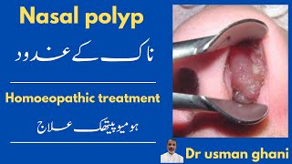 Nasal polyps  ناک کے غدود its homeopathic treatment Dr usman ghani [upl. by Hach]