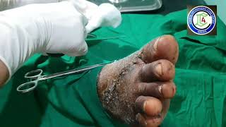 Dorsum Foot injury  Accidental axe injury foot  Kwire removal foot  Adamya Hosp videos [upl. by Far]